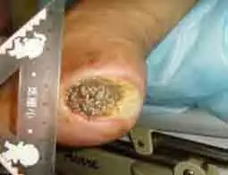 "用蛆治病"成为外科医药开发新热点