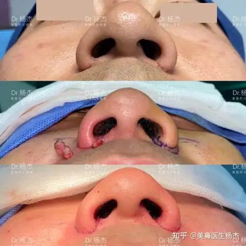 鼻翼缩小疤痕修复