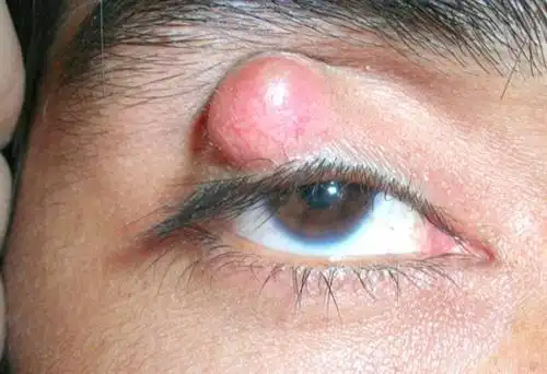 左眼睑板腺囊肿怎么办?