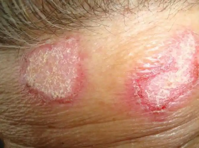 头皮上的红斑狼疮图片