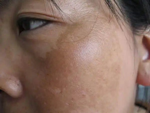 有黄褐斑的病因具体有哪些_黄褐斑_北京京城皮肤病医院(北京医保定点