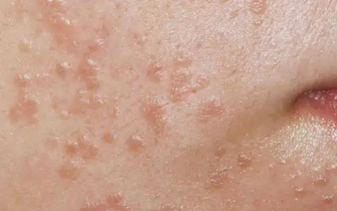 扁平疣轻微前期是什么样子图片大全