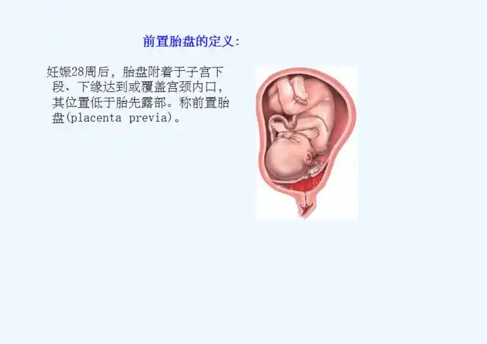 前置胎盘实用课件