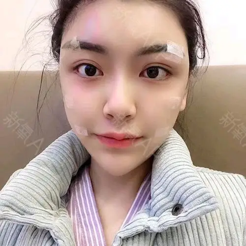 xinchen自体脂肪全脸填充术后第天美丽日记_新氧整形