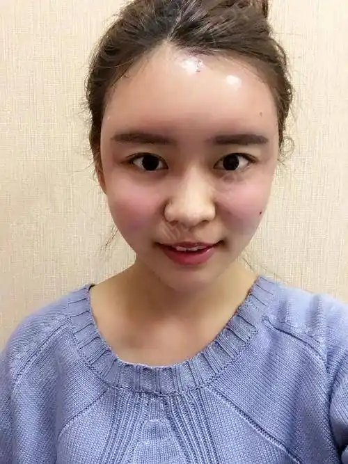 填充的是额头和面颊,这两个部位真的是我的硬伤,尤其.