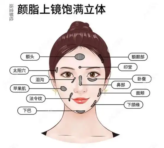 绍兴自体脂肪面部填充要多少钱按泪沟额头面颊等部位算