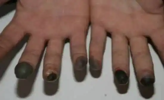 解冻复温后:皮肤逐渐变成褐色,黑色,出现明显坏死.