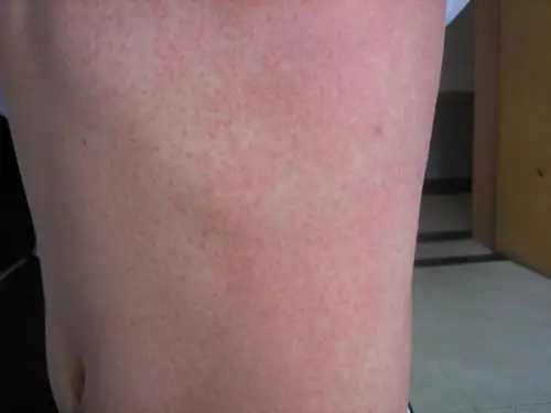 麻疹型药疹1例 - 皮肤及性传播疾病讨论版 - 爱爱医医学论坛