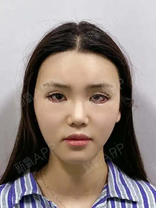 之前在外院做的下至外眼角手术,效果没有达到预期效果_圈子-新氧美容