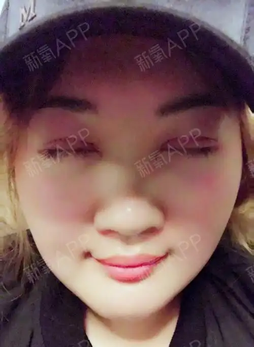 【全切双眼皮手术后第1天】