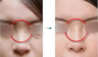 广西华美整形美容医院鼻子打玻尿酸 明星驻颜魔法