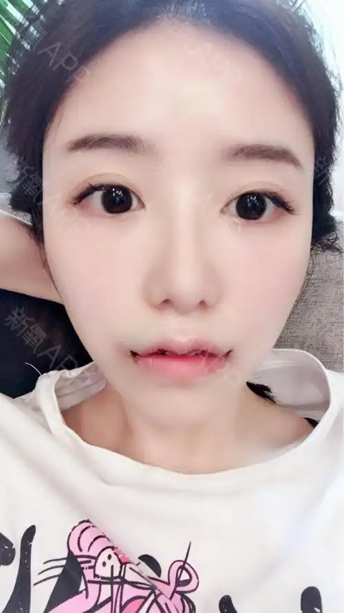成都玉颜唇部整形baby微笑唇综合手术当天关于嘴巴_圈子-新氧美容整形