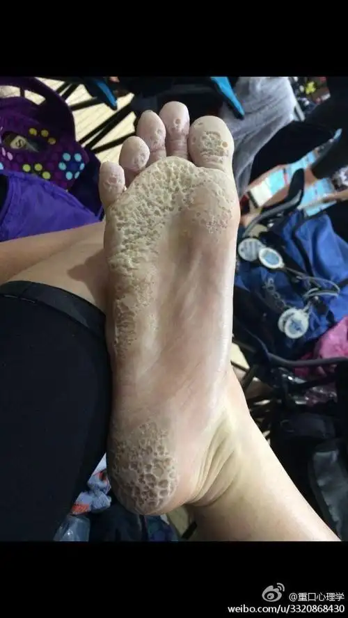 比臭脚更恶心比烂脚丫更可怕足跖蠹蚀症
