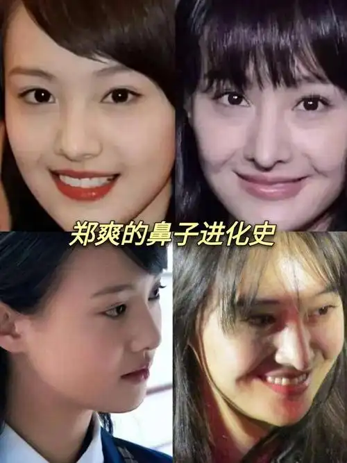 郑爽的鼻子进化史郑爽也是清纯型的长相,但很多人都跟_圈子-新氧美容