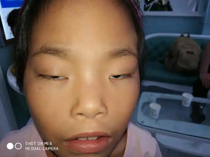 术前要排除重症肌无力,神经系统,胸腺及全身有关疾病.