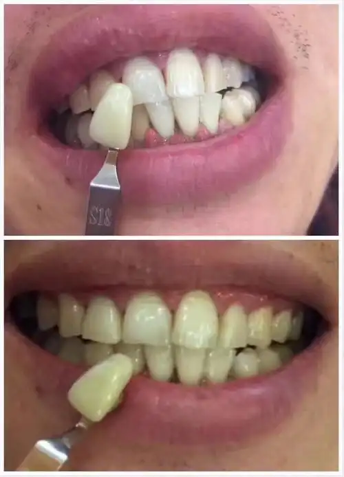 牙齿美白对比效果