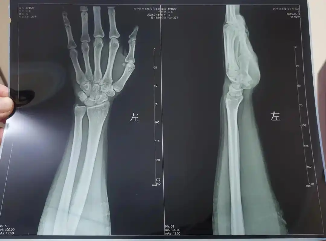 手腕背伸肌腱炎不能用力不能拧毛巾疼得一只碗都端不动