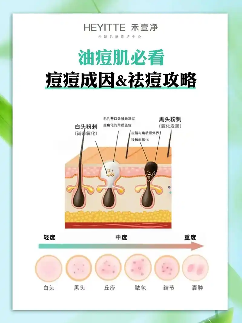 硬核祛痘攻略.#美容院加盟 长痘痘是很多女孩子的皮 - 抖音