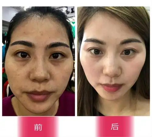 花几万都没治好的脸部色斑,喝2个月睡眠美全没了!_皮肤