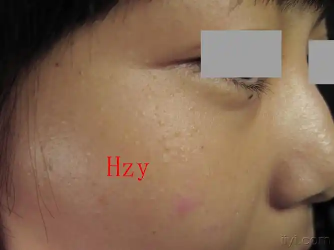 姑娘脸部的皮损