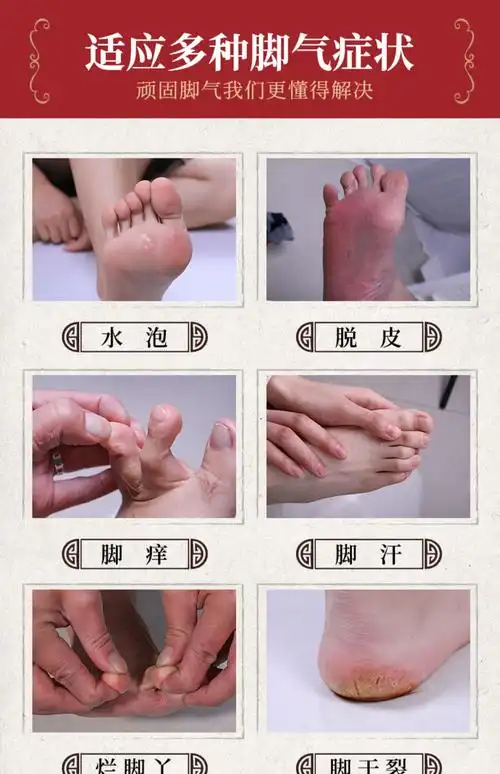 云南本草脚气喷剂止痒膏脱皮脚丫脚臭脚痒泡脚水烂抑菌杀菌除水泡