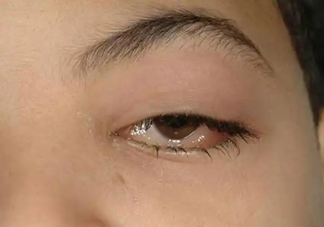 水肿图片慢性肾炎水肿图片肾病眼睑浮肿/水肿图片肾病早期面部水肿