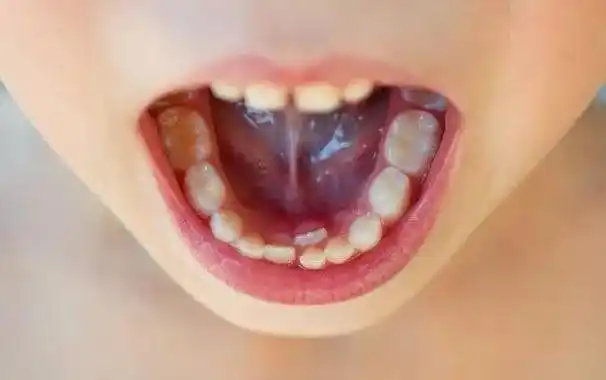 10个孩子里5个长双排牙,医生感叹:都是家长喂出来的!