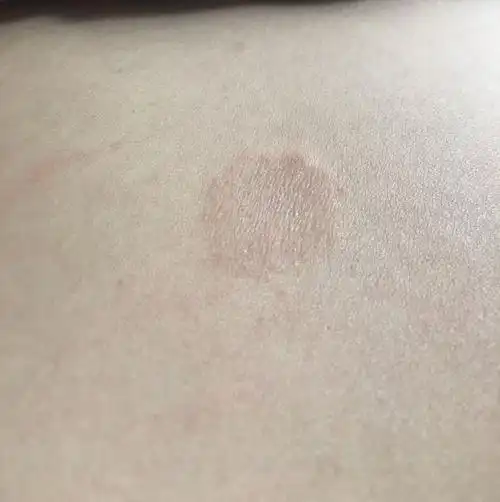 背部突然张了一块硬币那么大的东西