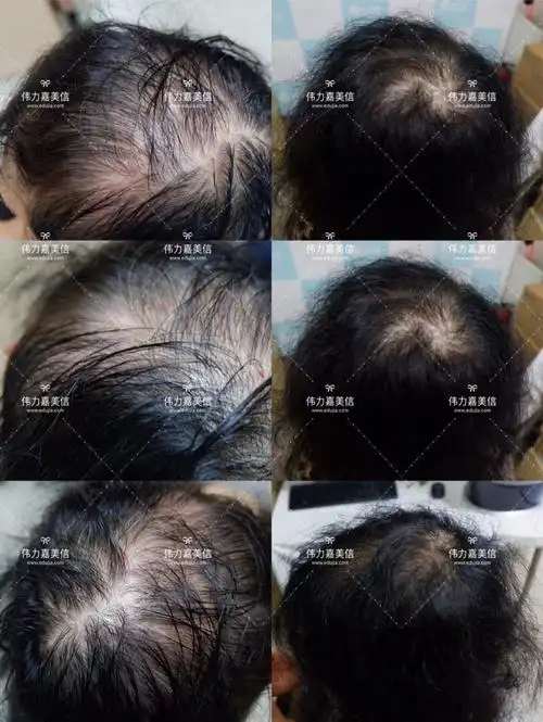 监利嘉美信mini微移植生发头顶前后对比照片