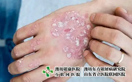 指甲牛皮肤癣图片症状