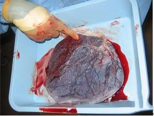 各位宝妈,你们的胎盘是怎么处理的?扔掉?卖了?还是自己吃了?