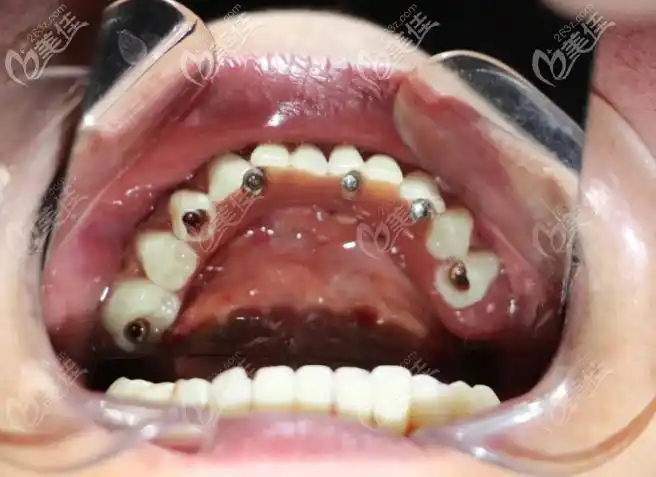即刻拔牙后做半口瑞士士卓曼钛锆亲水种植牙,花了8.8万