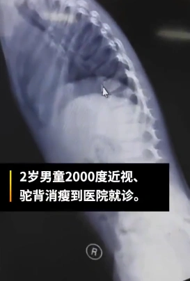 2岁男童近视两千多度确诊马凡综合征,医生:患病率低于万分之一