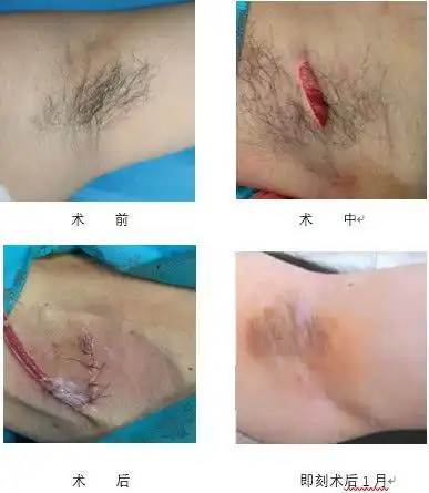 微创小切口解决大问题南院皮肤科开展小切口大汗腺修剪术治疗腋臭