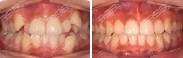 虎牙矫正案例对比