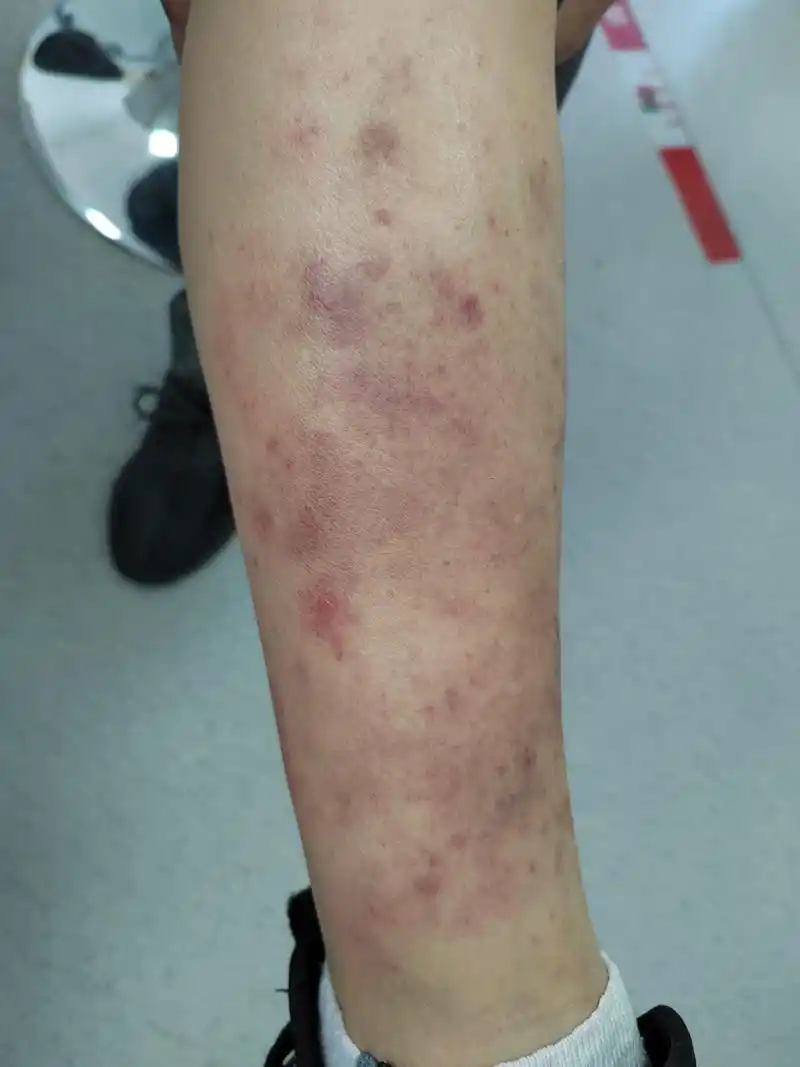 小腿部位的红斑丘疹症状.考虑夏季皮炎.