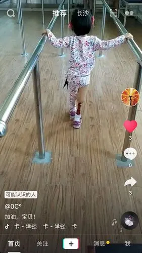 小女孩大腿假肢康复训练