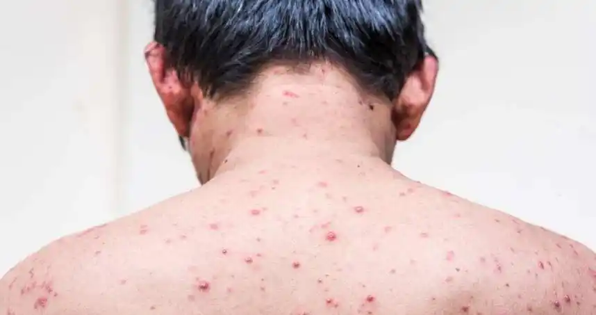 艾滋病皮疹及图片    皮疹有多种表现形式,症状比较轻的:皮炎,起水疱