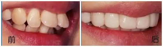 苏州成人龅牙矫正需要多少钱?