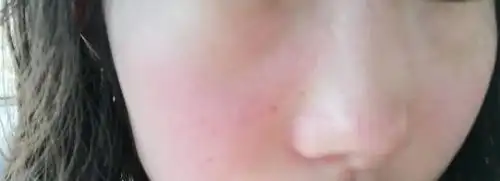 遇冷遇热皮肤泛红应该用什么修复😭