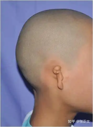 哪些因素会导致小耳畸形情况的发生呢?