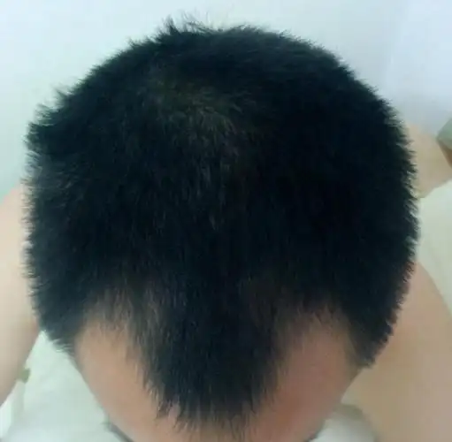 27岁男子发际线脱发成m型,用药半年还是没长出头发,还有救吗_手机搜狐