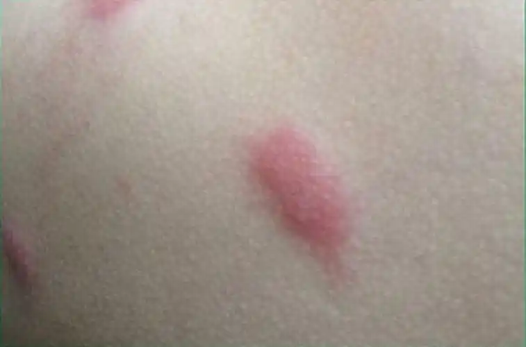 丘疹性荨麻疹红肿图片