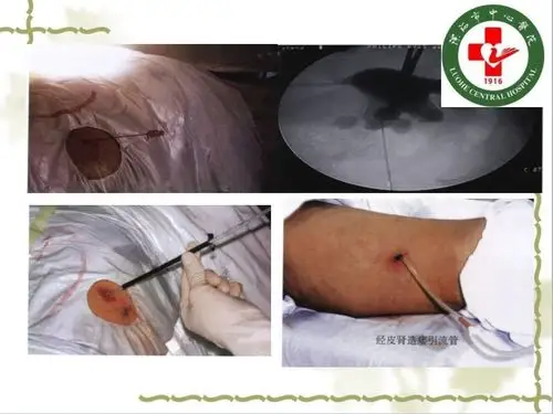 后尿道结石b型超声x线检查治疗舟状窝结石推挤或钳出前尿道结石推挤