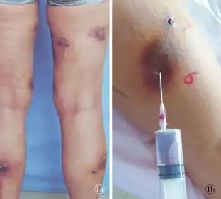 双下肢皮下脂肪注射溶脂药物后皮肤破溃一例