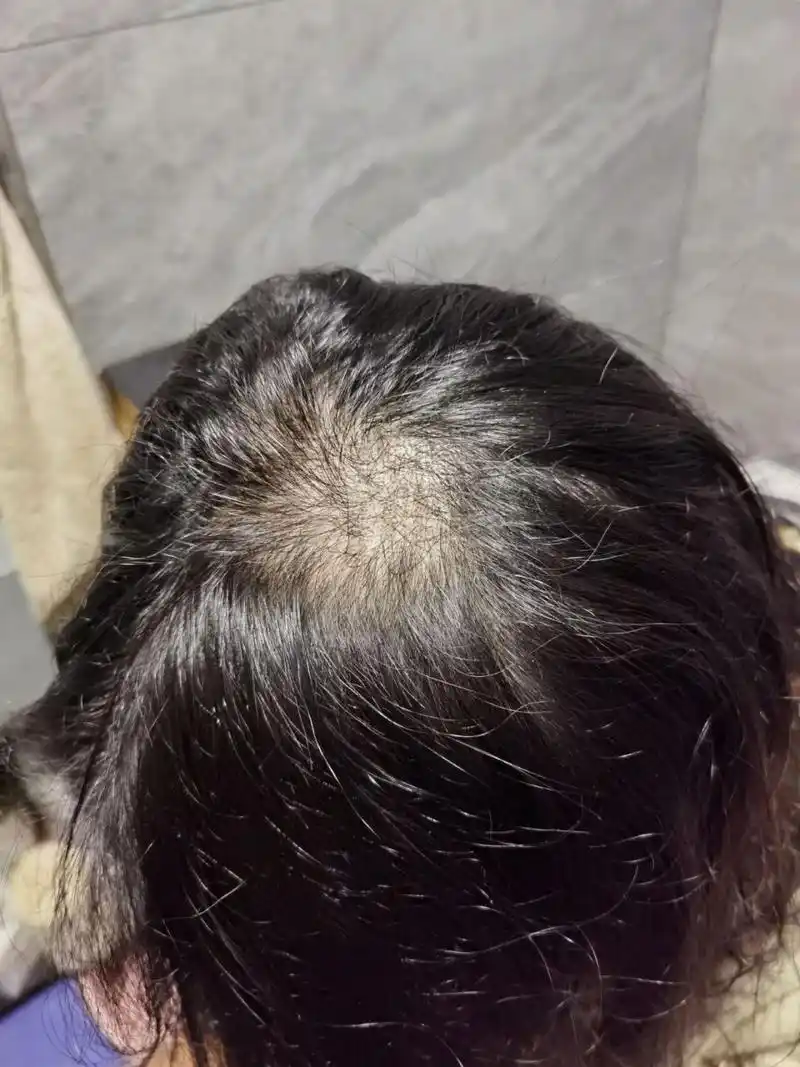 13岁女儿拔毛癖怎么办?