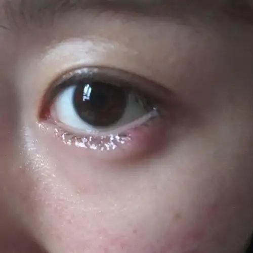 金霉素眼膏多少钱几块钱一支的红霉素眼膏