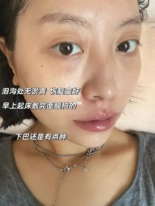 泪沟处完全没有不良反应  #去黑眼圈  #泪沟  #填充泪沟  #玻尿酸下巴