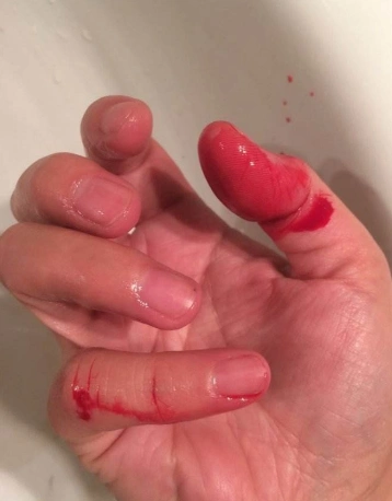 手出血的图片61