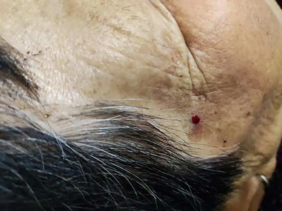 奶奶眼睛发红发炎红睁不开,昨 - 抖音